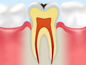 C1：エナメル質のむし歯