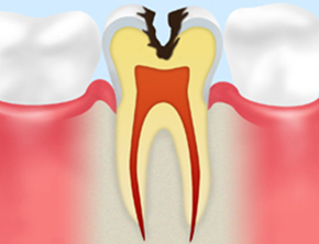 C2：象牙質のむし歯