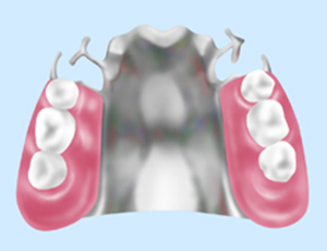 金属床義歯（ゴールド・チタン・コバルトクロム）