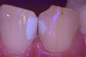 ブルーライトで虫歯治療した部分がより鮮明に