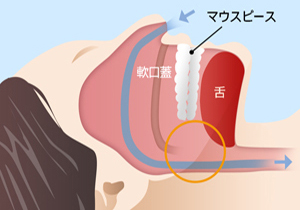 【睡眠時無呼吸症候群について】