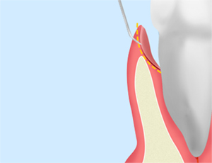 歯周ポケットそうは術