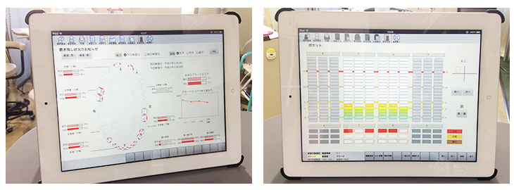 当院では検査結果を元に歯周ポケットの深さなどを、iPadを使用して患者様にわかりやすく説明しております。