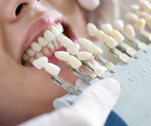 当院の審美歯科について
